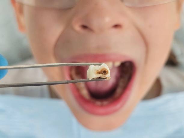 Best Cracked Tooth Emergency Dentist  in Pioneer, CA